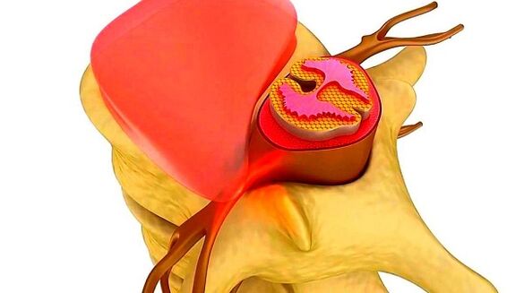 The essence of the thoracum waist osteocondrosis