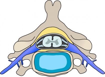 Protabius in Vertebra in cervical osteocondrosis