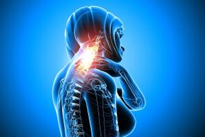 osteocondrosis in cervical spine