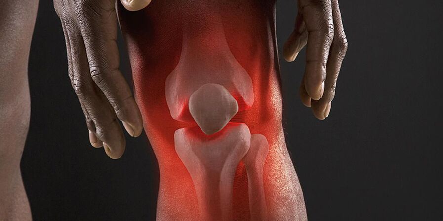 The burning sensation in the knee area is a sign of gonarthrosis